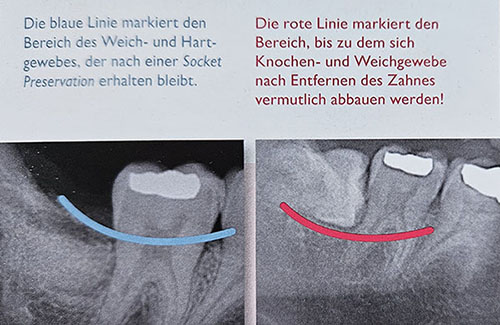 Smart Grinder - Knochenaufbau mit dem Smart Grinder-Verfahren